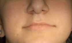 Patient initial presentation showing congenitally missing teeth and collapsed bite at age 16